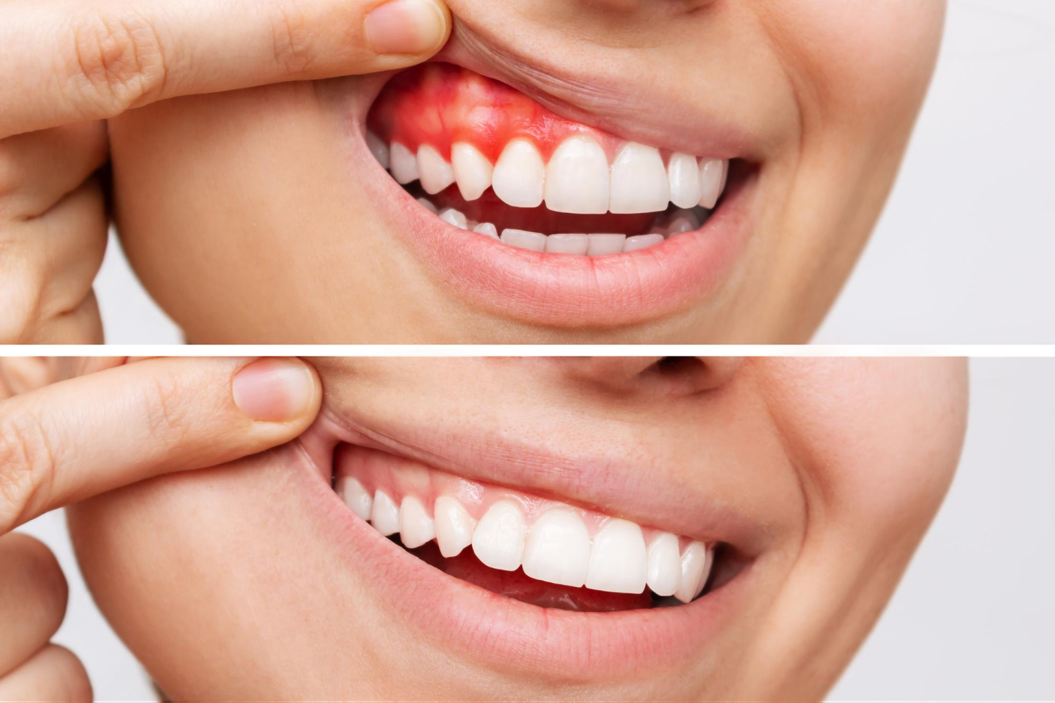 Gum Disease Treatment