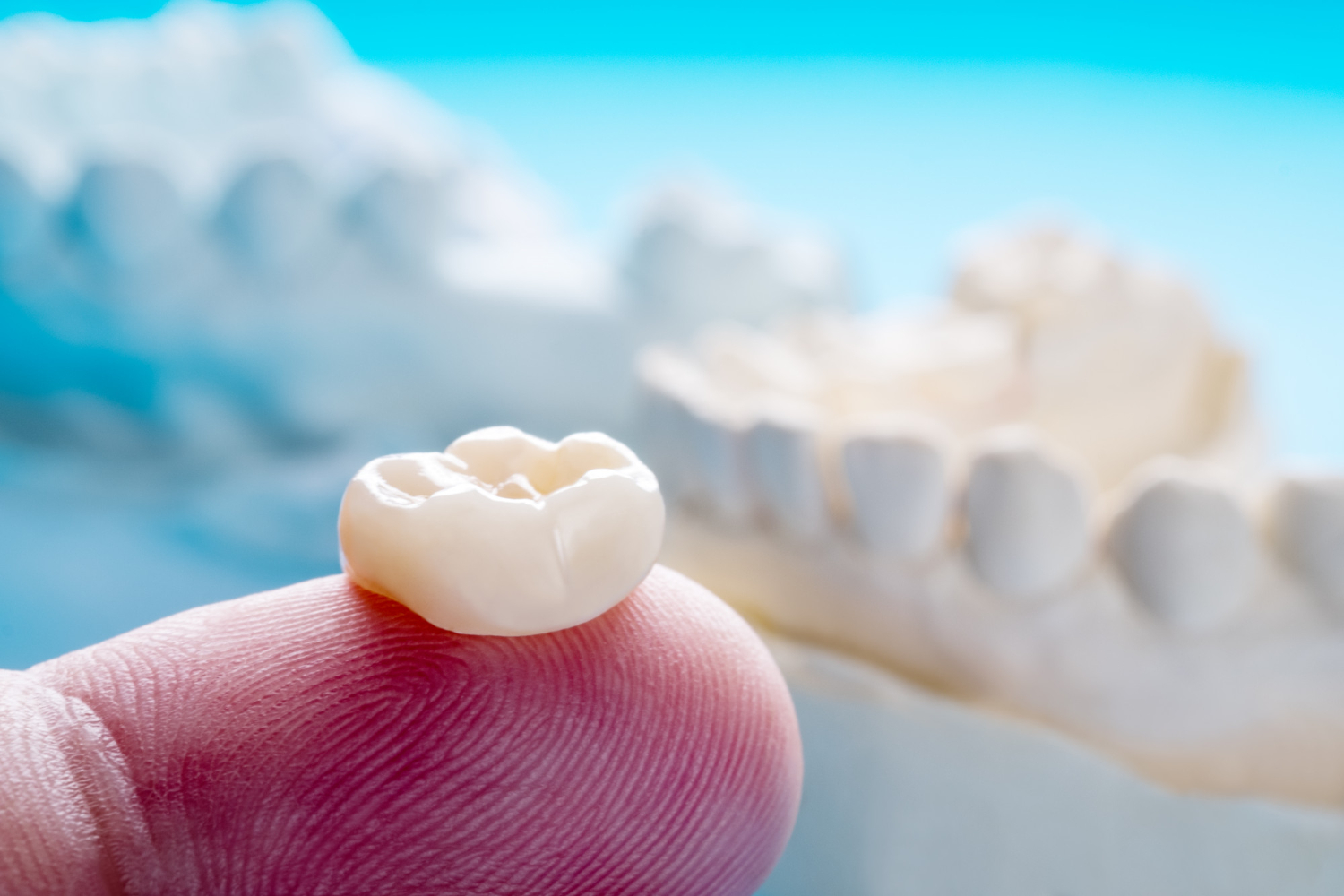 Dental Bridges