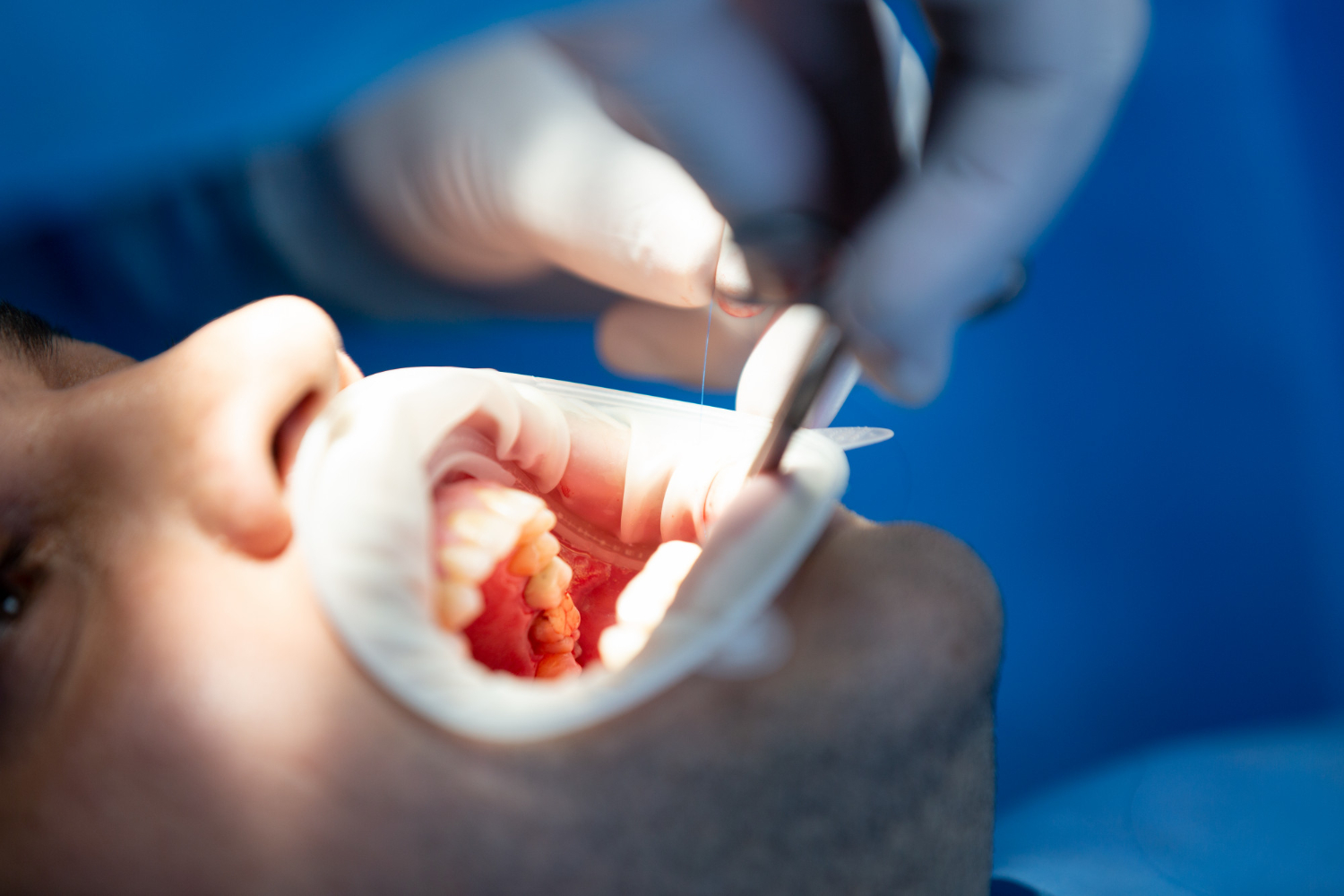 Dental Restoration